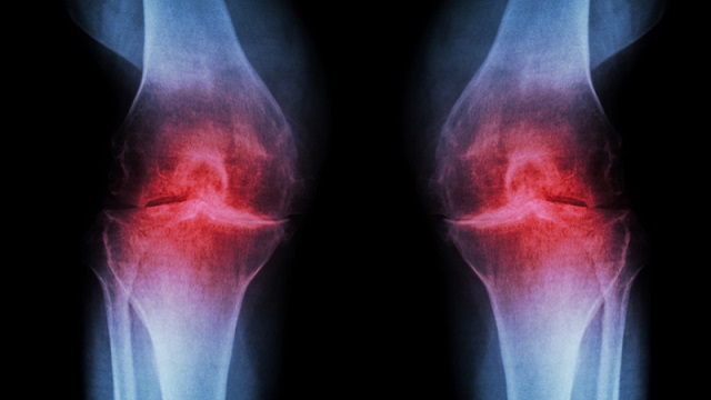 Osteoarthritis Knee ( OA Knee )