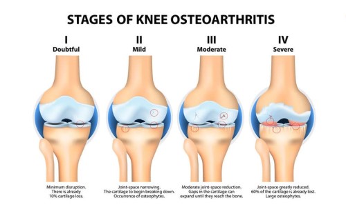stem cell therapy for knees